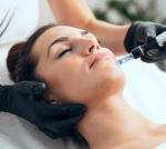 Microneedling